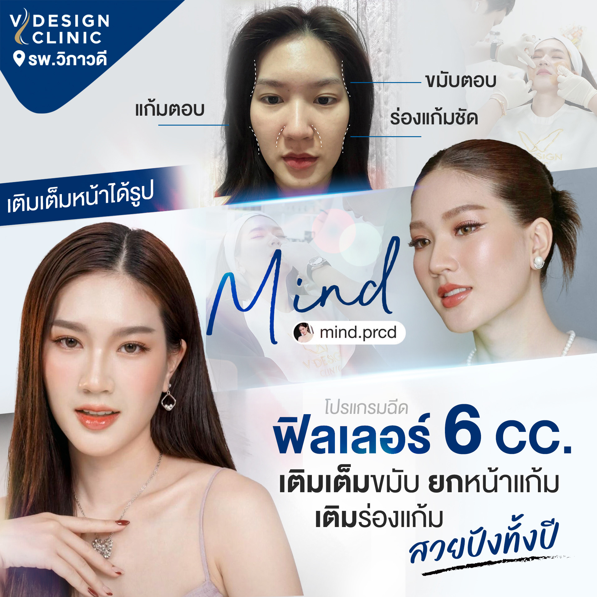 ฉีดฟิลเลอร์