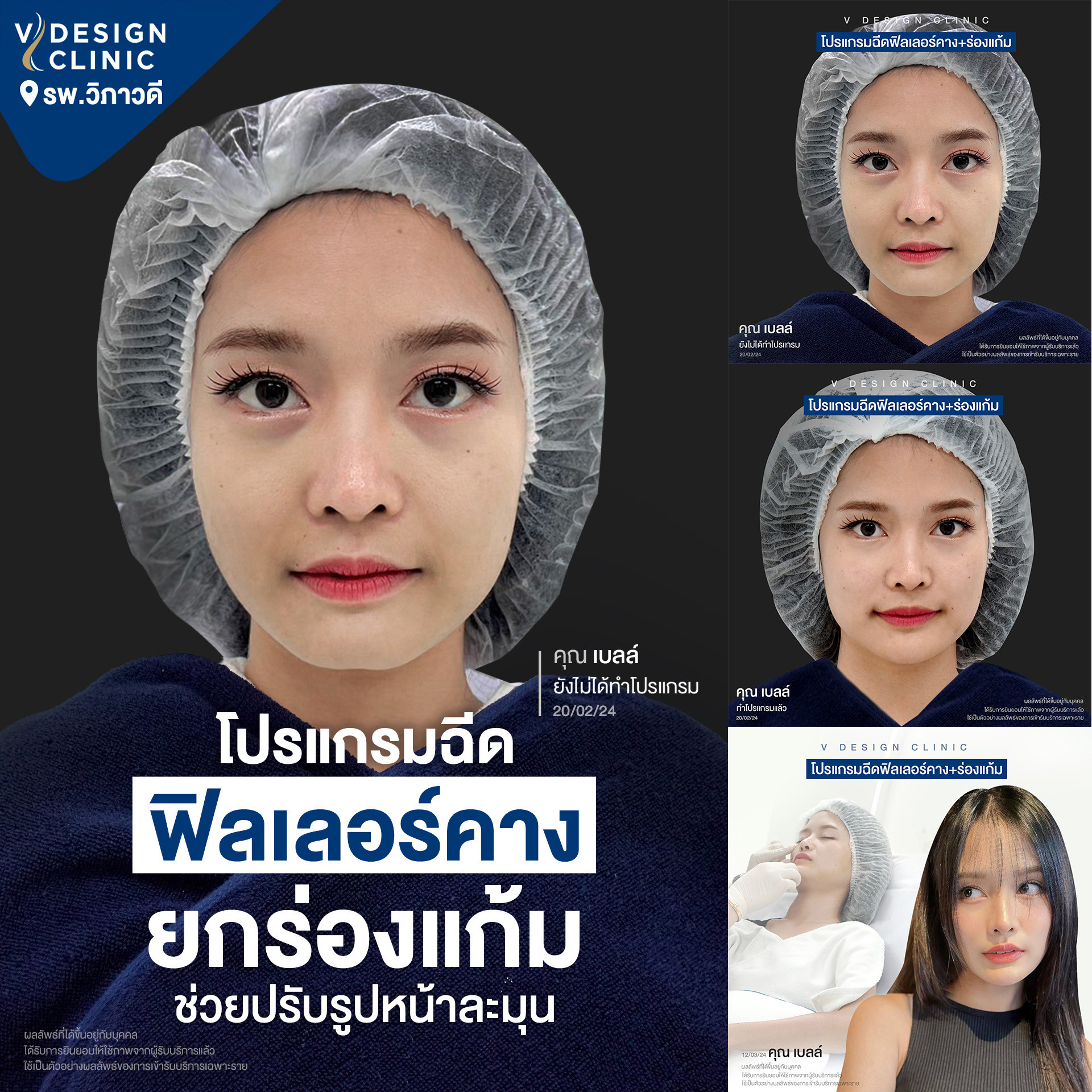 ฉีดฟิลเลอร์