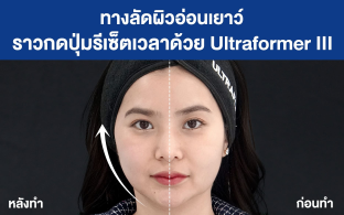 ทางลัดผิวอ่อนเยาว์ ราวกดปุ่มรีเซ็ตเวลาด้วย Ultraformer III